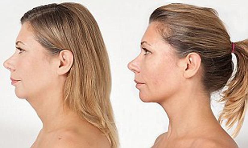 Hindi Boynu Görünümünü Tedavi Edebilir misiniz?